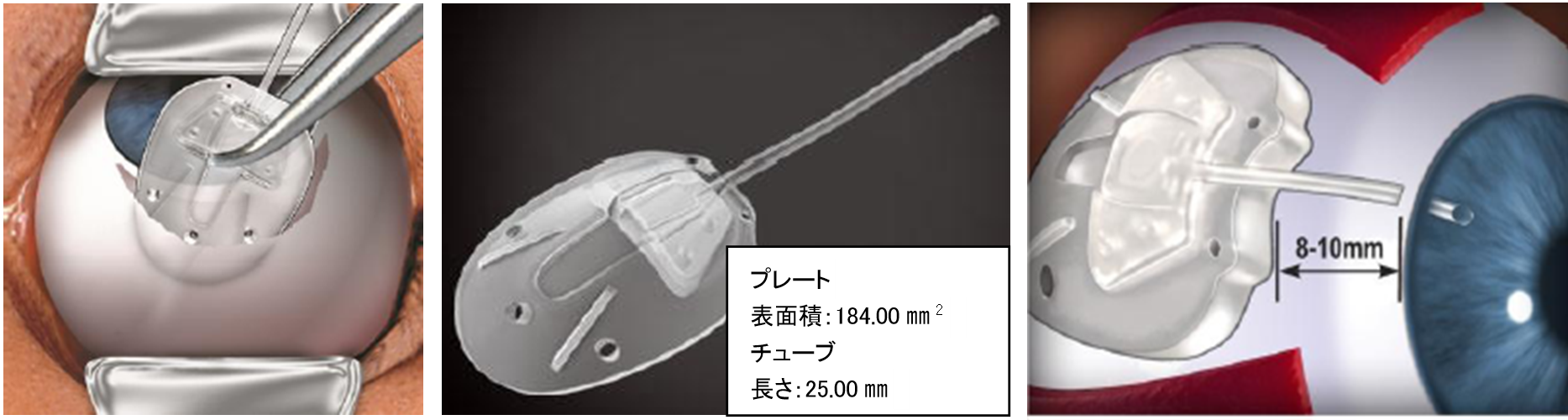 Expressチューブシャント
