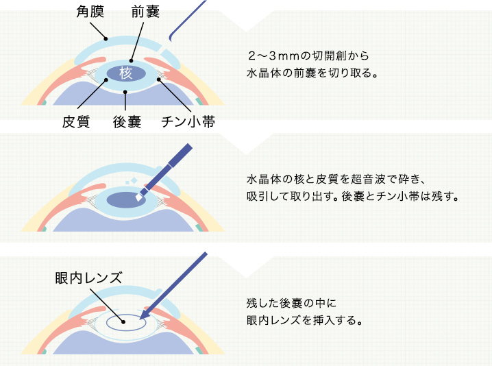 白内障手術の流れ