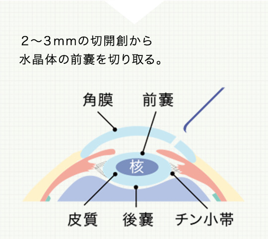 白内障手術の流れ